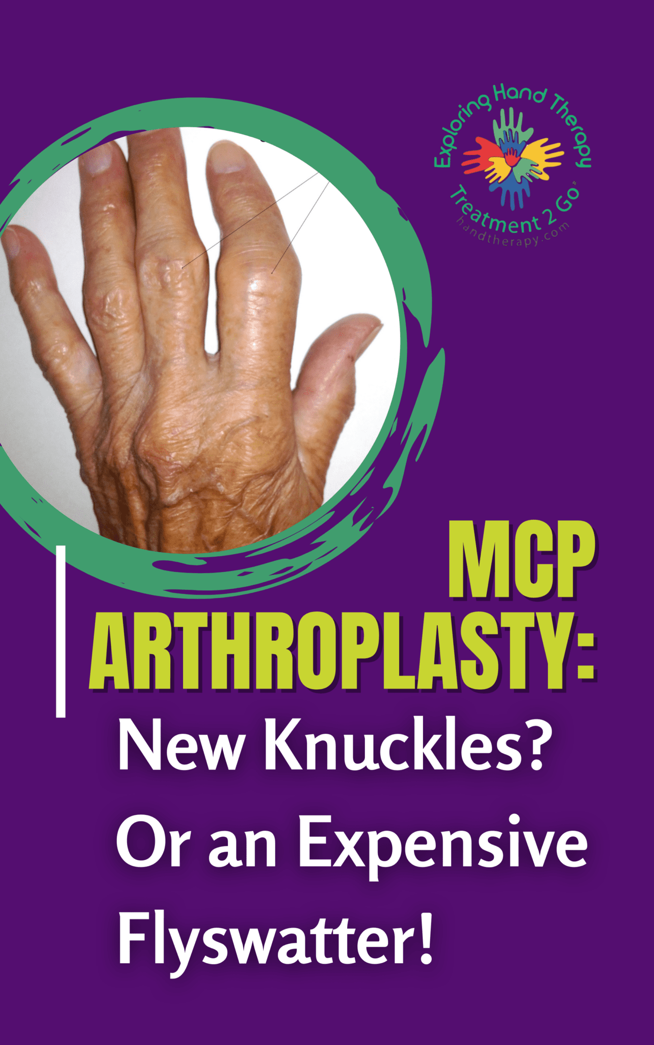 MCP Arthroplasty: New Knuckles?  Or an Expensive Flyswatter!