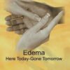 Edema Management:  Here Today, Gone Tomorrow