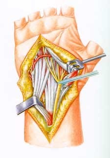 Flexor Tendons: Get Your Glide On (Interactive movie)